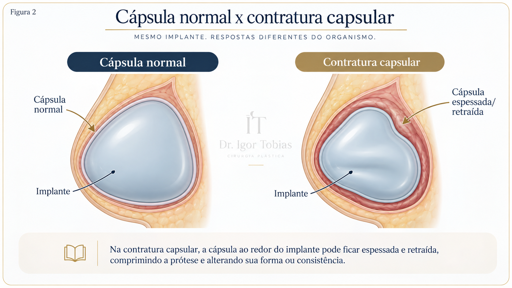 Comparação entre cápsula normal e contratura capsular ao redor da prótese mamária