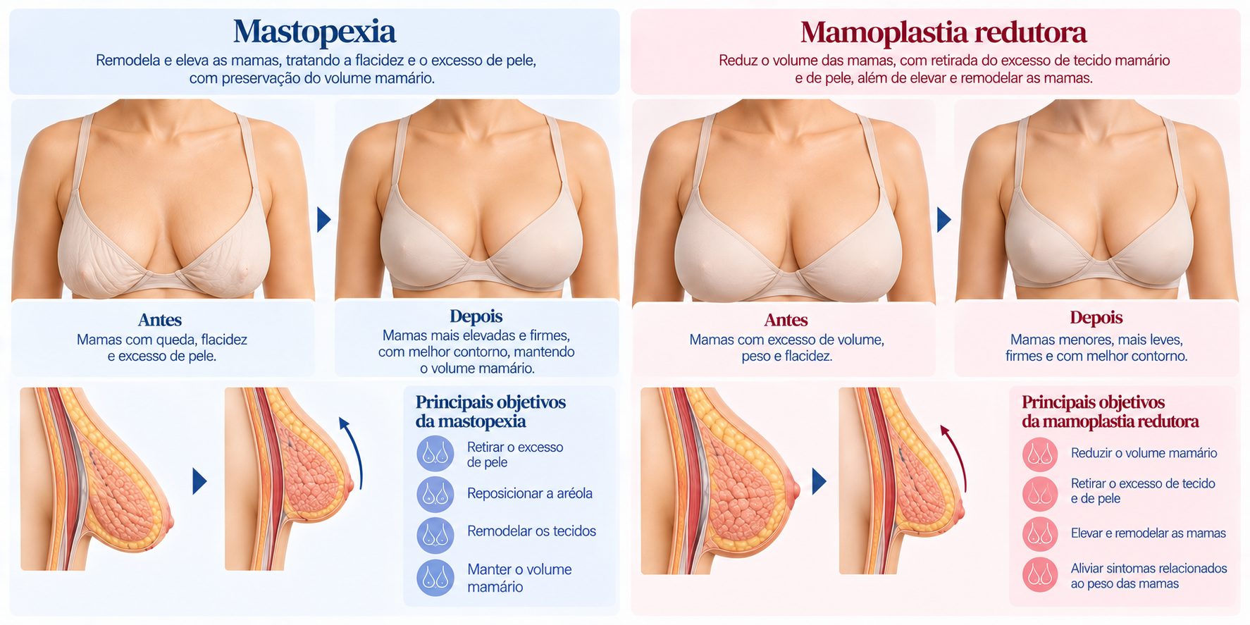 Comparação entre mastopexia e mamoplastia redutora para tratamento das alterações mamárias após grande perda de peso.