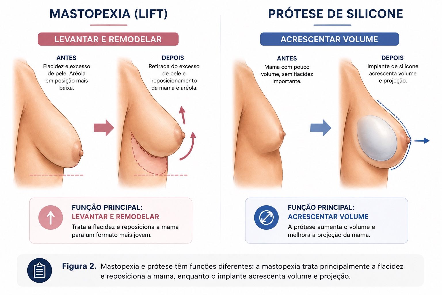 Ilustração explicando a diferença entre mastopexia para levantar a mama e prótese de silicone para acrescentar volume