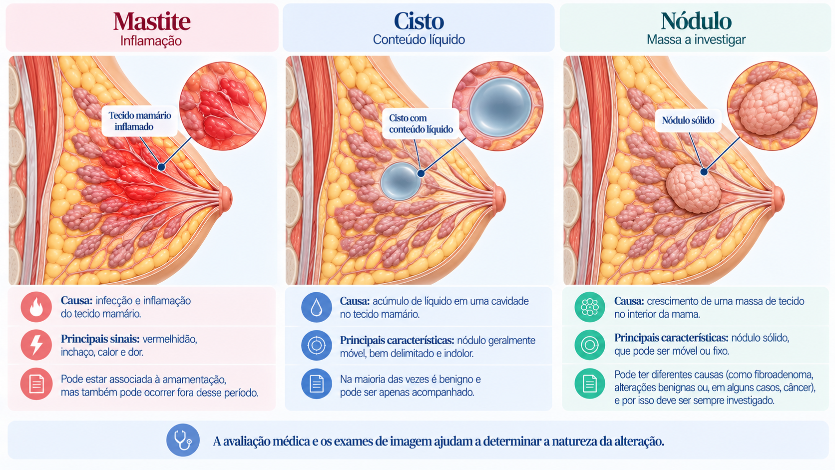 Infográfico comparando mastite, caracterizada por inflamação, cisto mamário preenchido por líquido e nódulo sólido no tecido mamário.