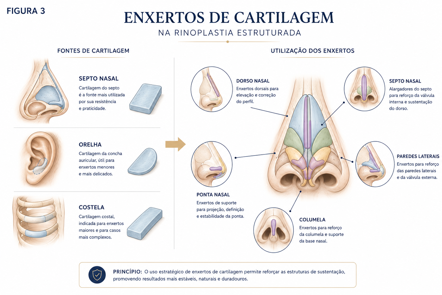 Representação das principais fontes de cartilagem utilizadas para enxertos na rinoplastia estruturada.