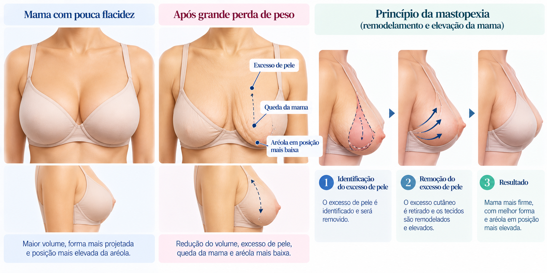 Ilustração médica mostrando excesso de pele e queda das mamas após grande perda de peso e o princípio da mastopexia.