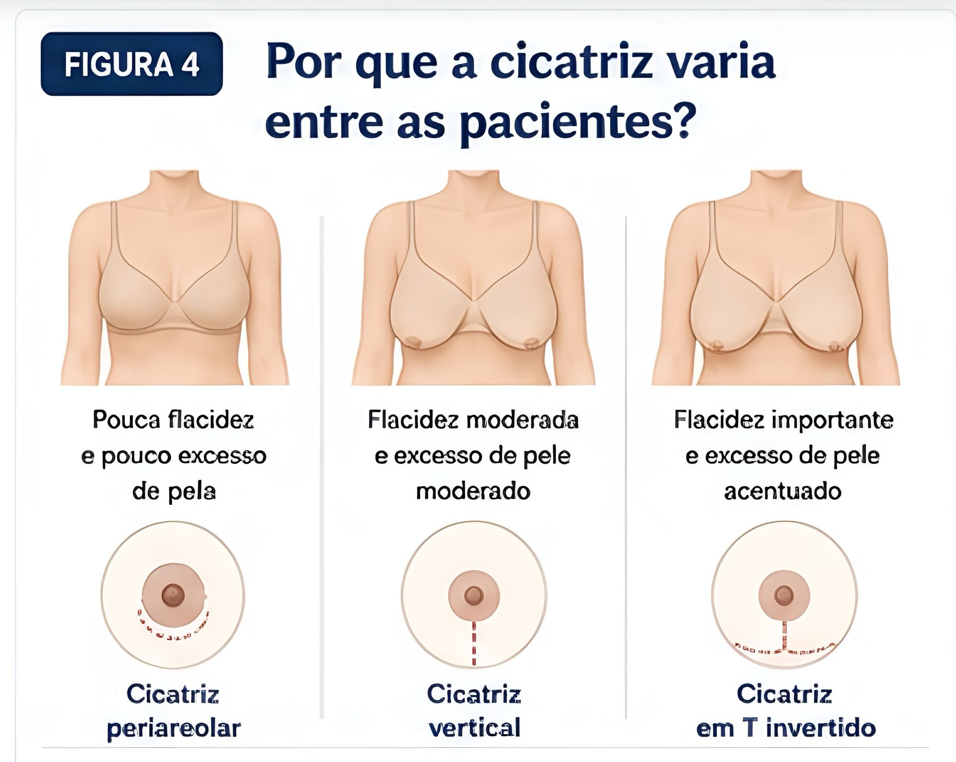 Fatores que influenciam a extensão da cicatriz na mastopexia.