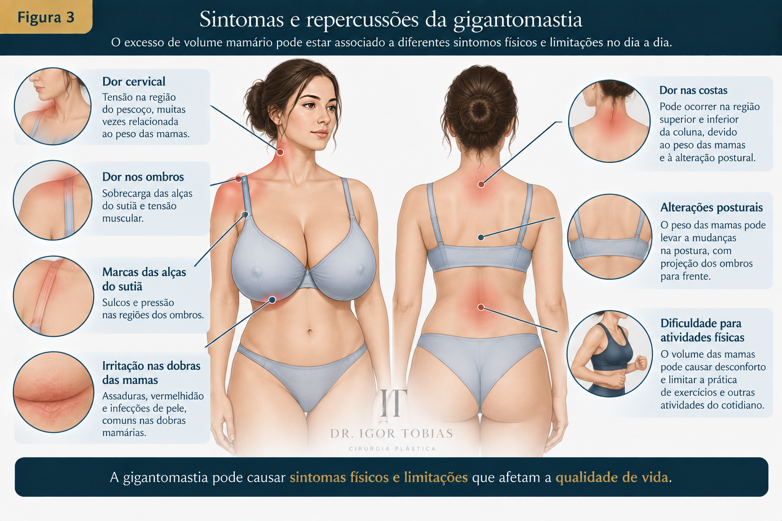Ilustração médica dos principais sintomas associados à gigantomastia, como dor nas costas, pescoço e ombros, marcas do sutiã, irritação da pele e dificuldade para atividades físicas.