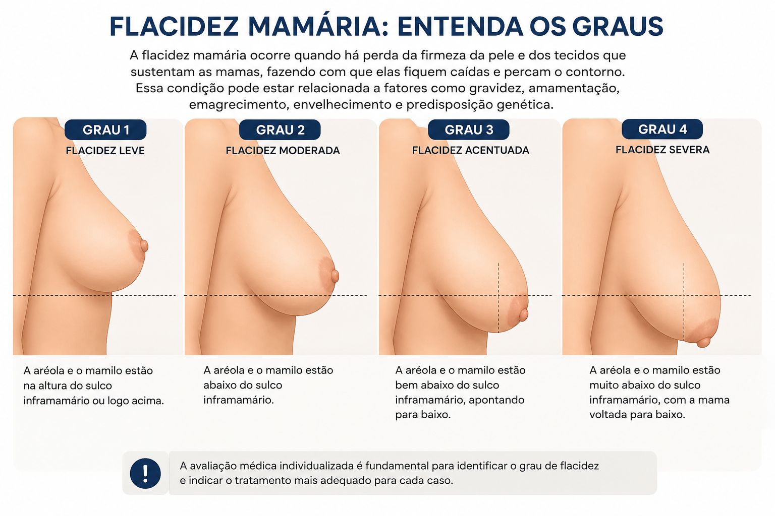 Graus de ptose mamária mostrando a posição da aréola em relação ao sulco inframamário nos graus leve, moderado, acentuado e severo.
