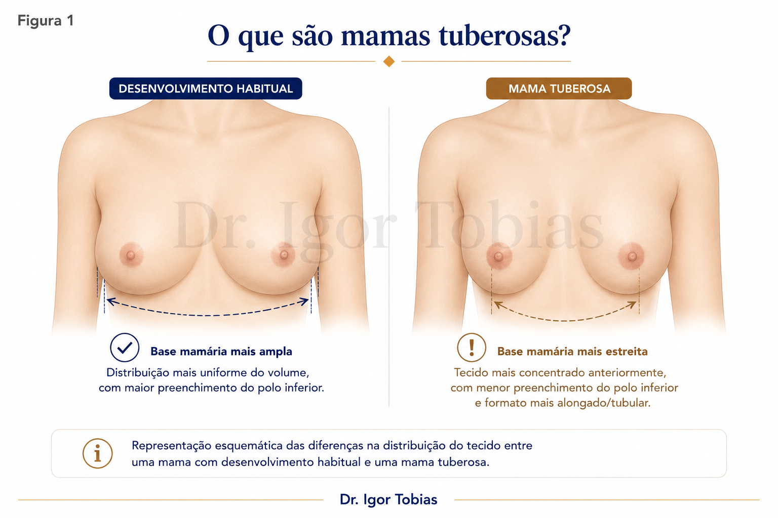 Comparação entre mama com desenvolvimento habitual e mama tuberosa
