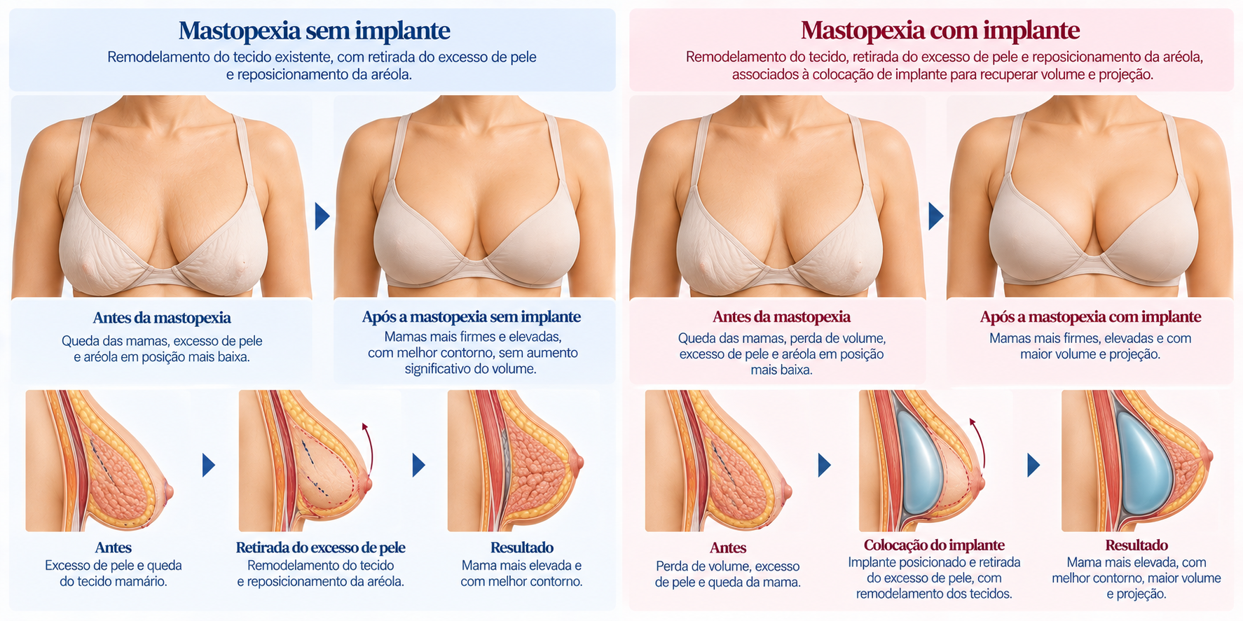 Comparação entre mastopexia sem implante e mastopexia com implante após grande perda de peso.