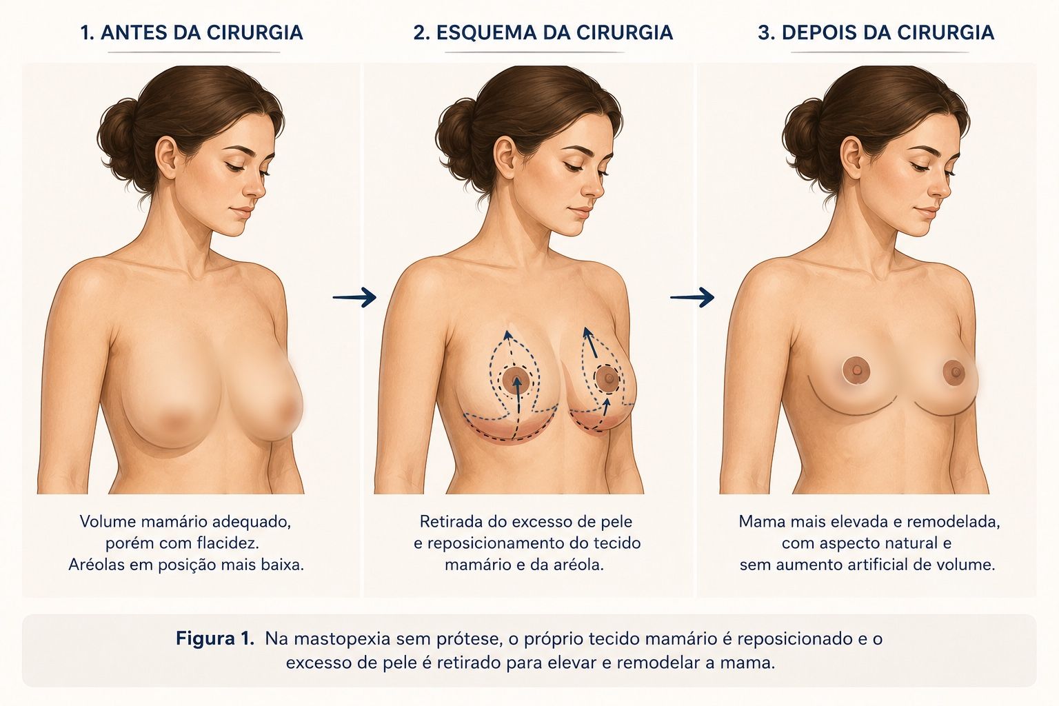 Ilustração mostrando mama com flacidez antes e após mastopexia sem prótese de silicone