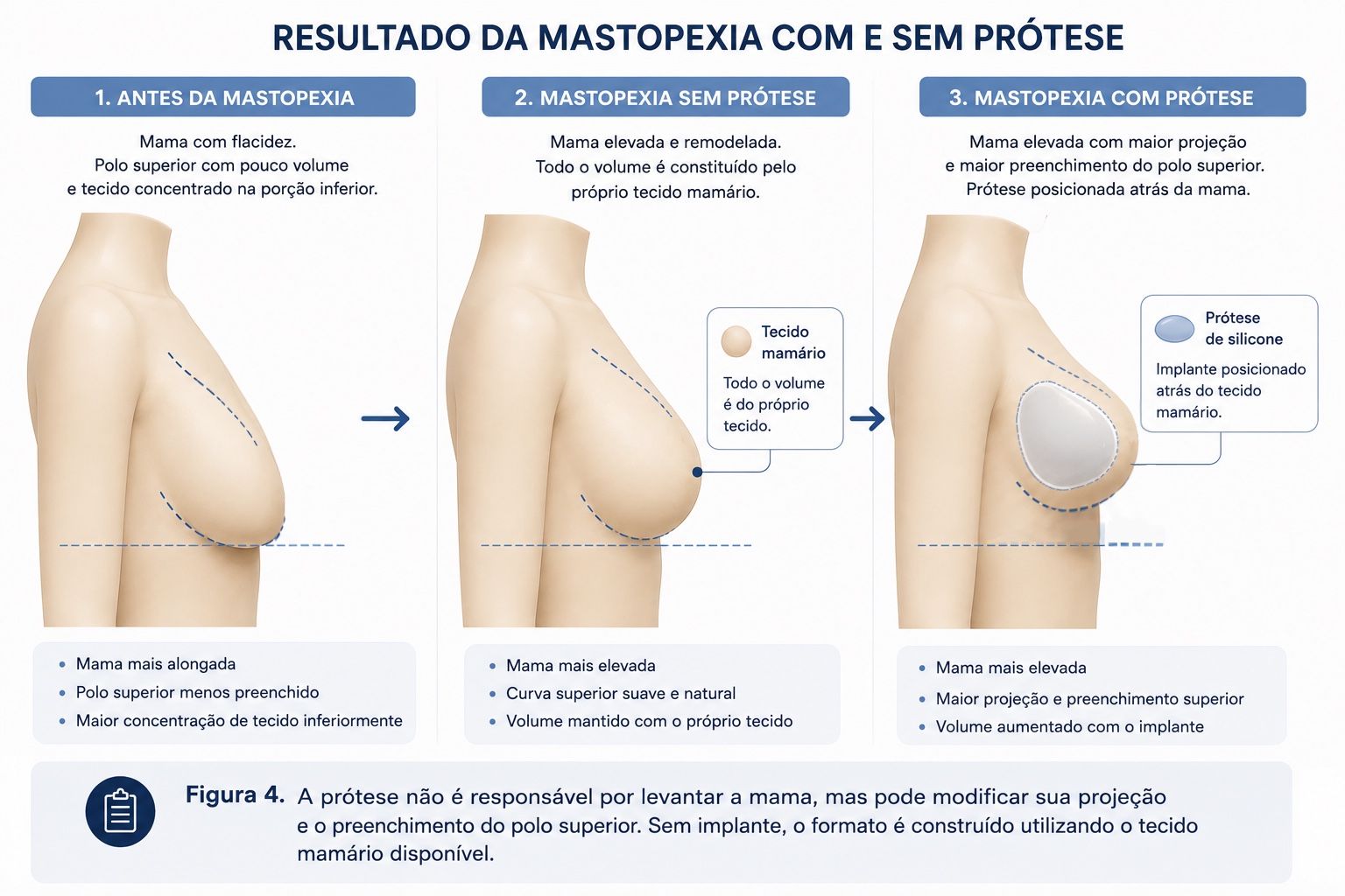 Comparação do formato da mama após mastopexia sem prótese e mastopexia com prótese de silicone