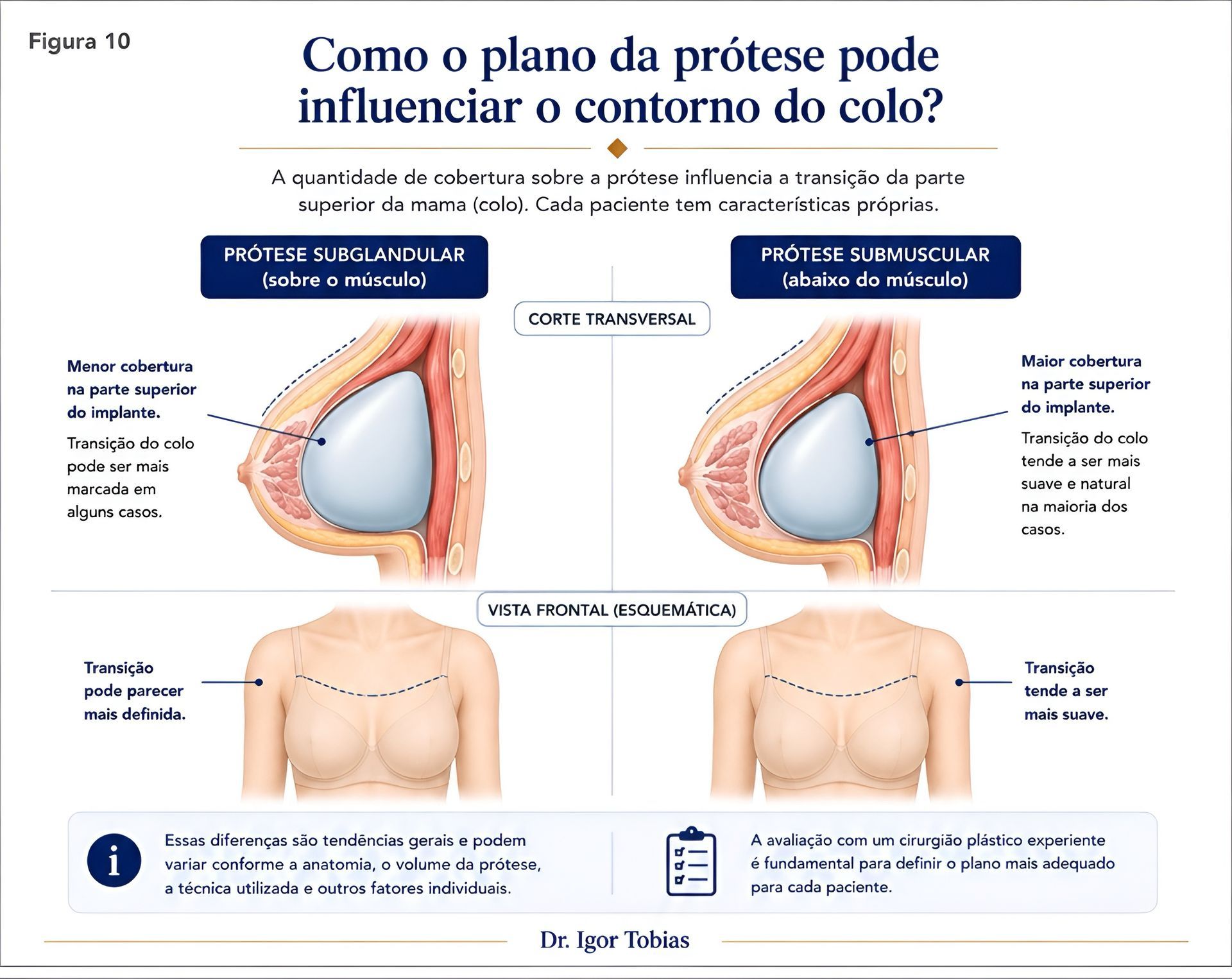 Influência do plano da prótese no contorno superior das mamas