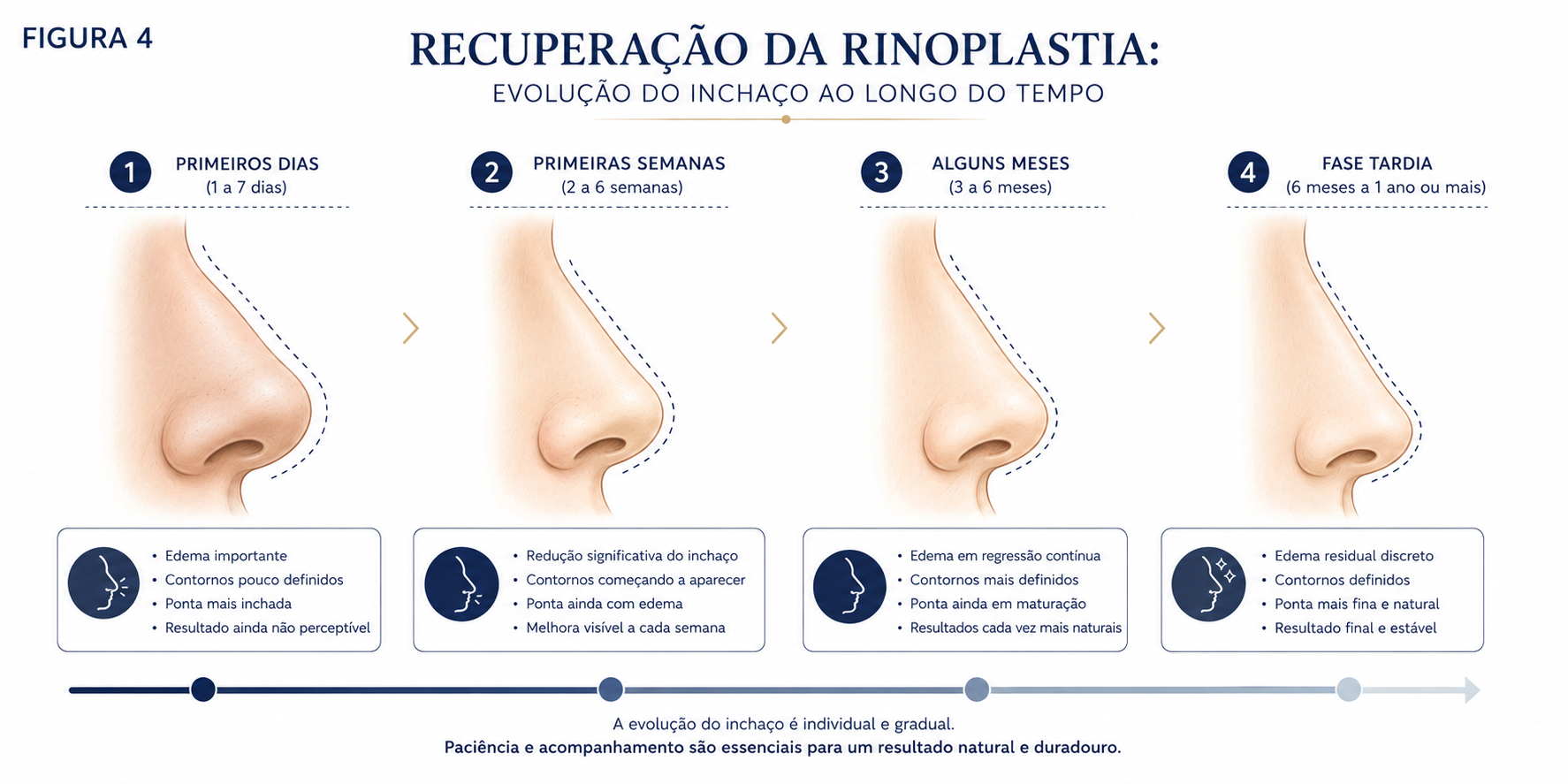 Ilustração da evolução do inchaço e da definição nasal durante a recuperação da rinoplastia.
