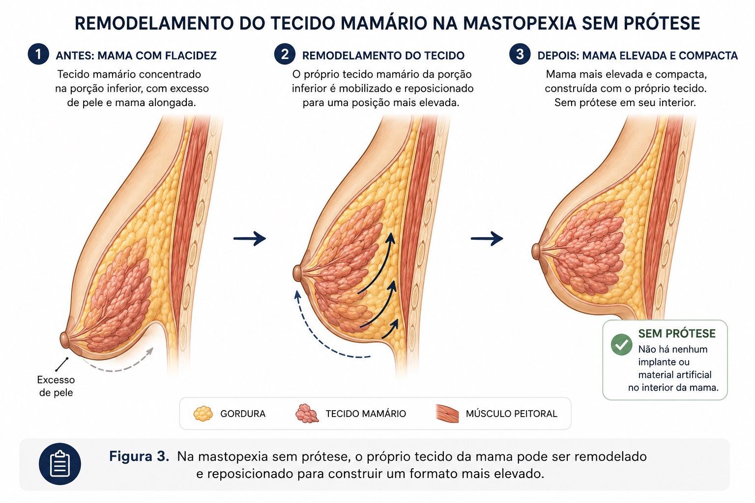 Ilustração mostrando o reposicionamento do próprio tecido mamário durante mastopexia sem prótese