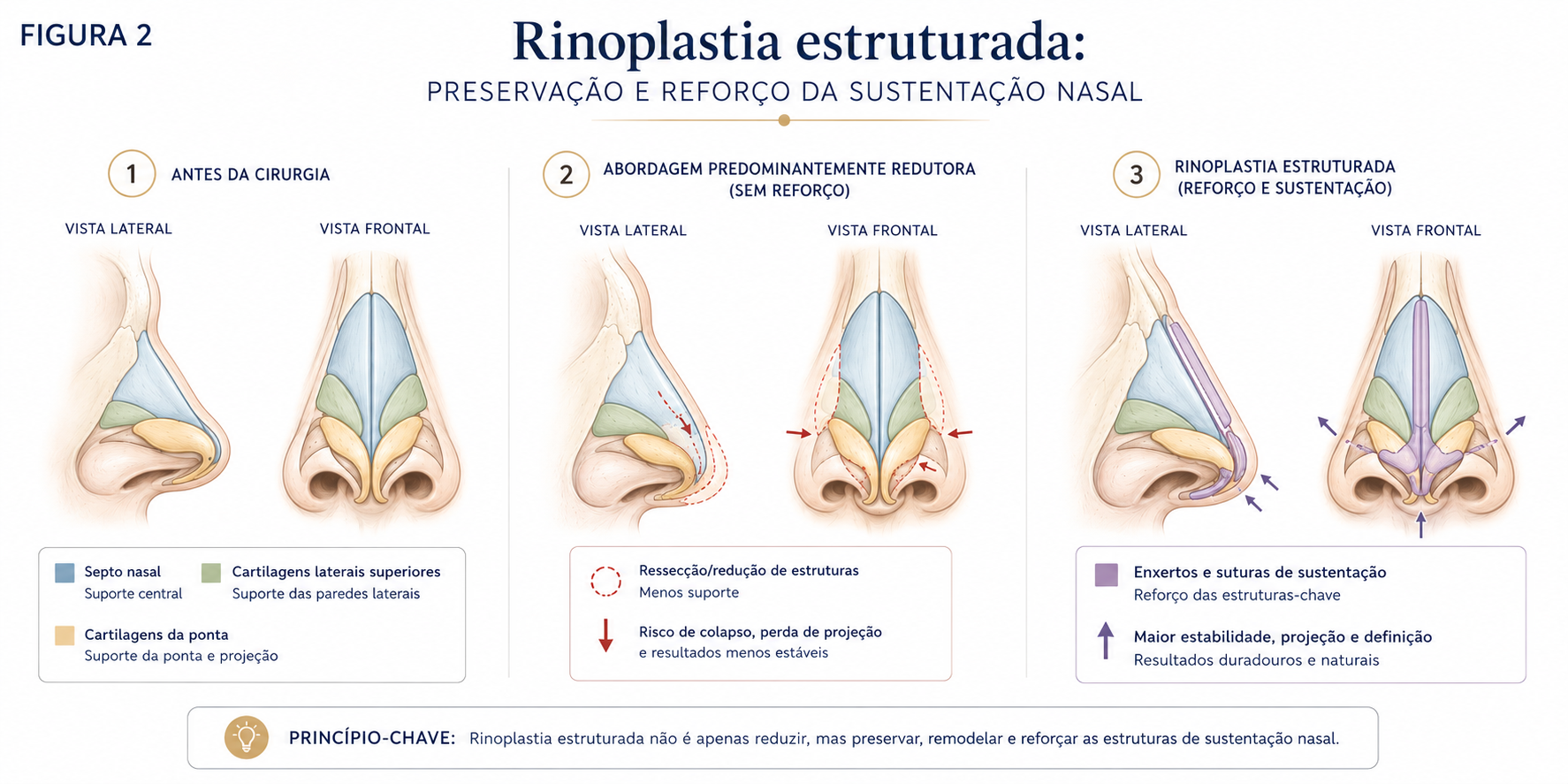 Comparação esquemática entre remodelamento nasal e reforço estrutural na rinoplastia.