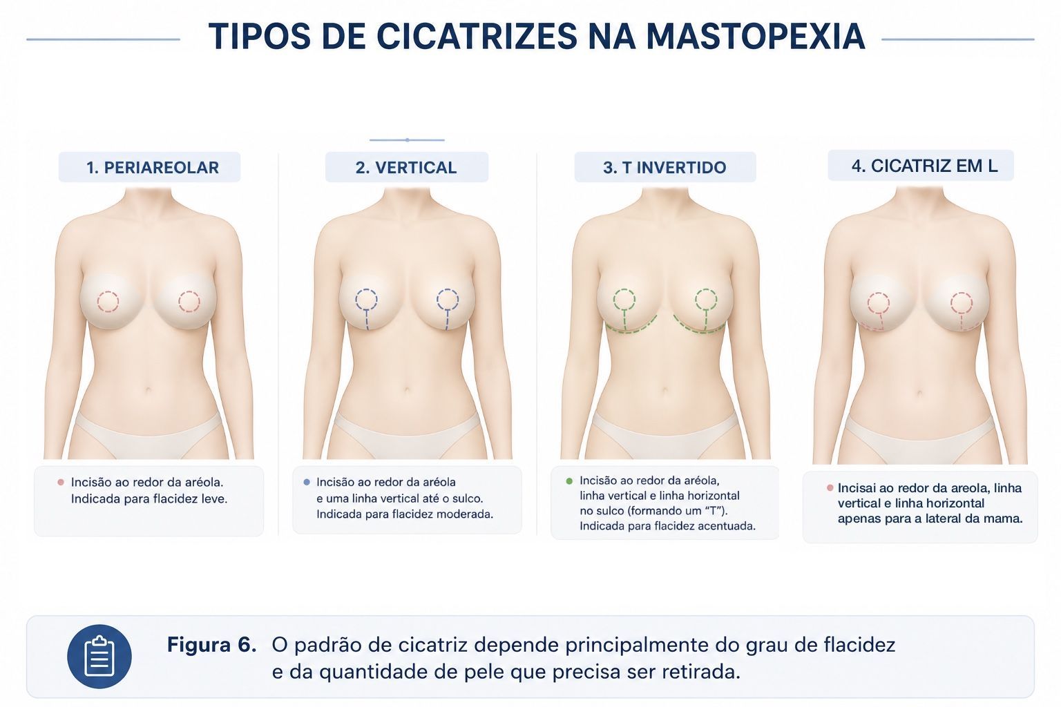 Ilustração comparando cicatriz periareolar, vertical e em T invertido na mastopexia.