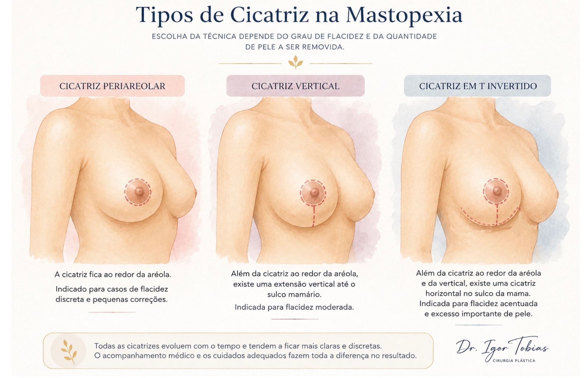 lustração mostrando os principais tipos de cicatriz na mastopexia: periareolar, vertical e em T invertido.