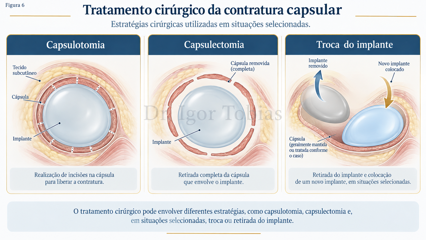 Ilustração das opções cirúrgicas para tratamento da contratura capsular