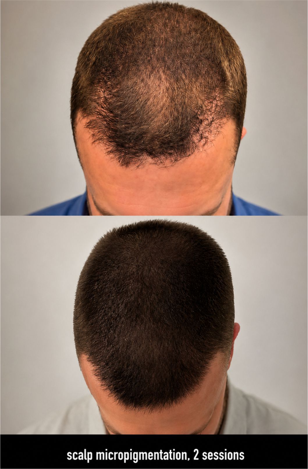 Before and after scalp micropigmentation: thinning hairline above, fuller-looking scalp below