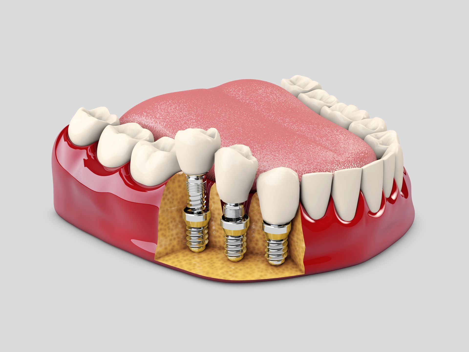 A 3D model of a human jaw showing three dental implants placed in the gum line, with prosthetic crowns attached.