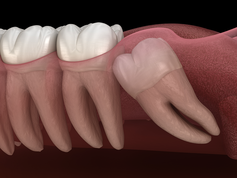 A 3D medical illustration showing a third molar (wisdom tooth) impacted horizontally against the adjacent molar.
