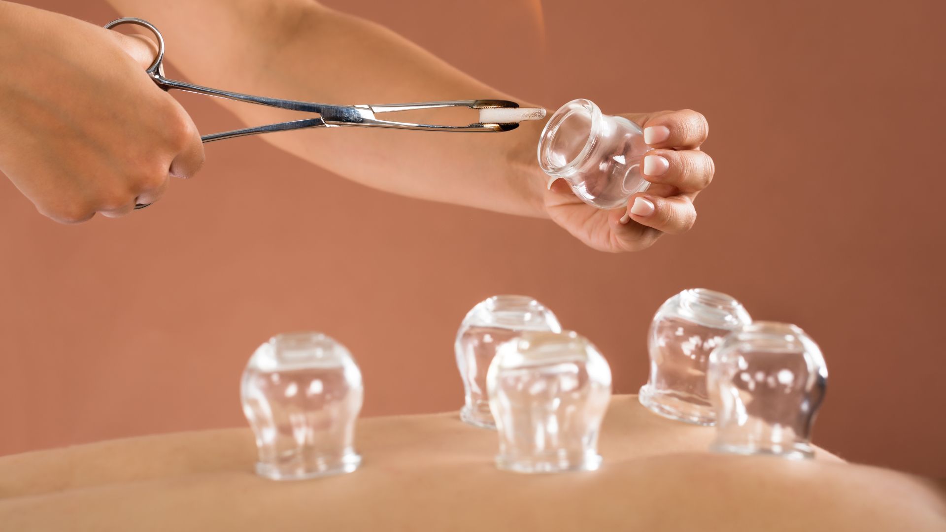 Hand using cupping therapy cups on a bare back, with several glass cups visible nearby.