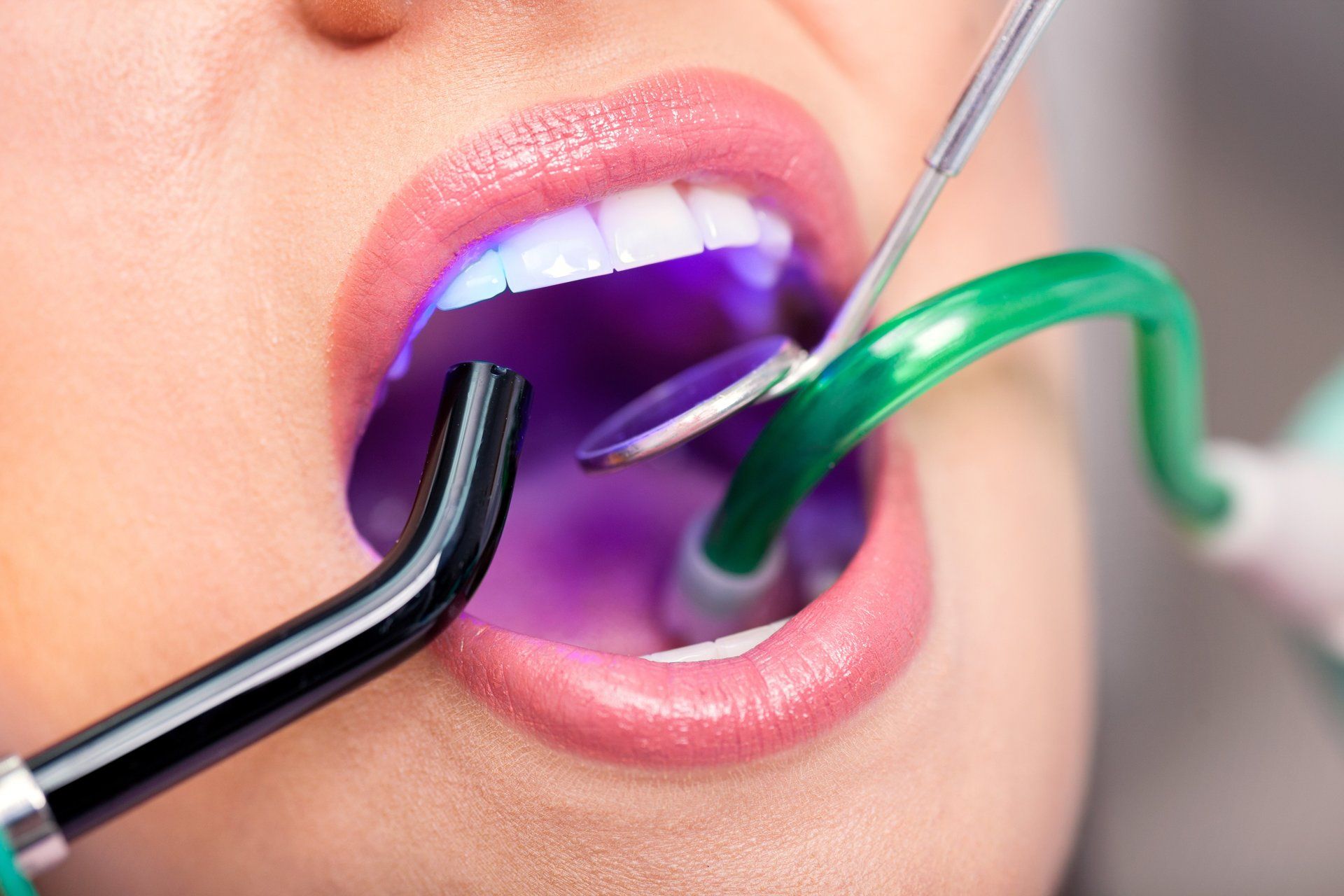 Woman at the dentist with mouth open; dentist shining curing light and using a mirror.