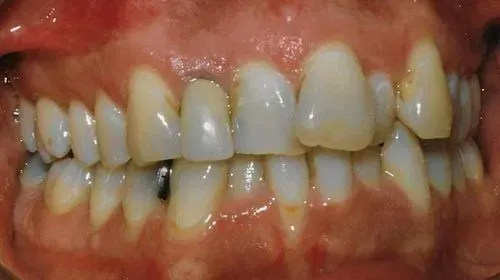 Teeth: side view shows stained and misaligned teeth with a cavity.