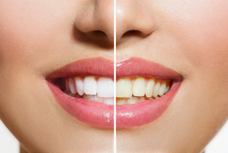 Split image: One side shows stained teeth, the other side shows whitened teeth.