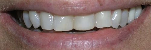 Close-up of a person smiling, showing a full set of white teeth.