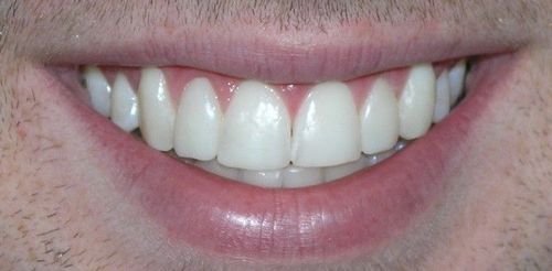 Close-up of a man's smiling mouth, showing white teeth and pink gums and lips.