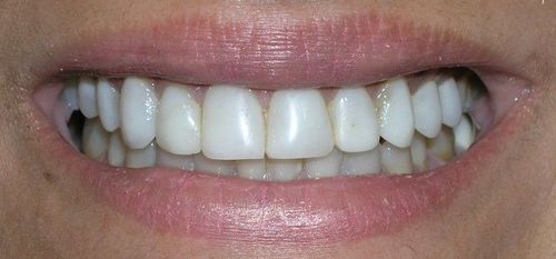 Close-up of a person's smiling mouth, showing bright white, straight teeth and pink lips.
