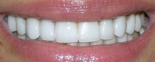 Close-up of a smiling mouth, showing bright white teeth and pink lips.