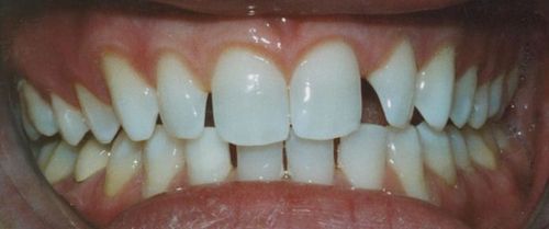 Close-up of a mouth showing teeth with gaps and slightly crooked appearance.