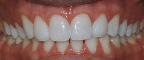 Close-up of a person's teeth, showing a bright white smile, pink gums, and natural tooth color at the back.