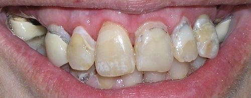 Close-up of yellowed, damaged teeth in an open mouth. Gums are red and inflamed.