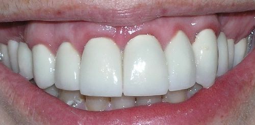 Close-up of teeth. The teeth are very white, in a mouth with pink gums and lips.