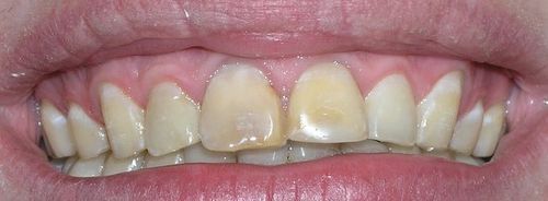 Close-up of a person's mouth, showing yellowed teeth and pink gums.