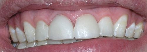 Close-up of human teeth, showing healthy, white teeth and pink gums.