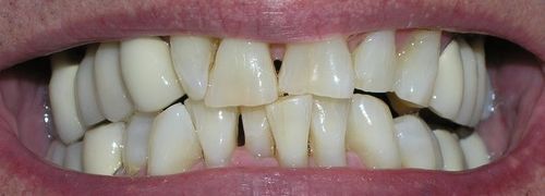 Close-up of a person's teeth, showing yellowed color and overcrowding in the mouth.