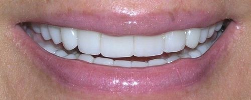 Close-up of a smiling person with shiny, pink lips and bright white teeth.