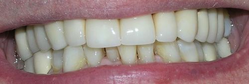 Close-up of teeth and gums. The teeth are white with visible yellowing. Mouth open slightly.