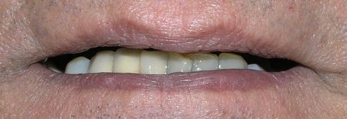Close-up of a person's mouth showing partially visible teeth and lips. The teeth have varying yellow tones.