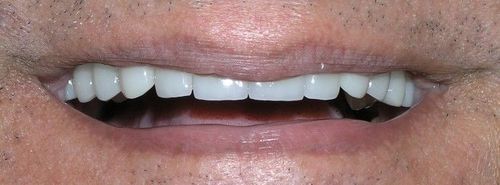 Close-up of a person's mouth with bright white teeth, showing a smile. The teeth appear to be dental work.