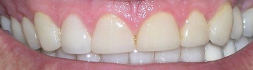 Close-up of teeth; creamy white color. Pink gums, visible upper and lower teeth.