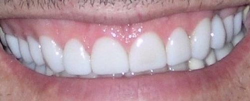 Close-up of a smiling mouth showing bright, white, aligned teeth, with pink gums, and light-colored skin.