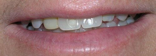 Close-up of a smiling mouth with a slight overbite. The teeth are white and the lips are pink.