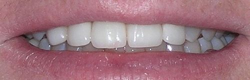 Close-up of a person's mouth showing white teeth. The lips are slightly parted.