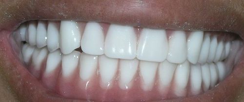 Close-up of a mouth with very white teeth and pink gums.