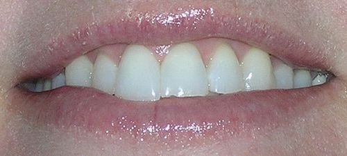 Close-up of a person's smiling mouth, showing bright white teeth and glossy pink lips.