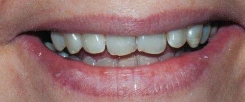 Close-up of a person's smiling mouth, showing teeth and lips. The lips are pink, with a slightly visible lip line.