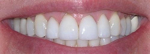 Close-up of a person's teeth, showing a bright, white smile. Pink lips frame the teeth.